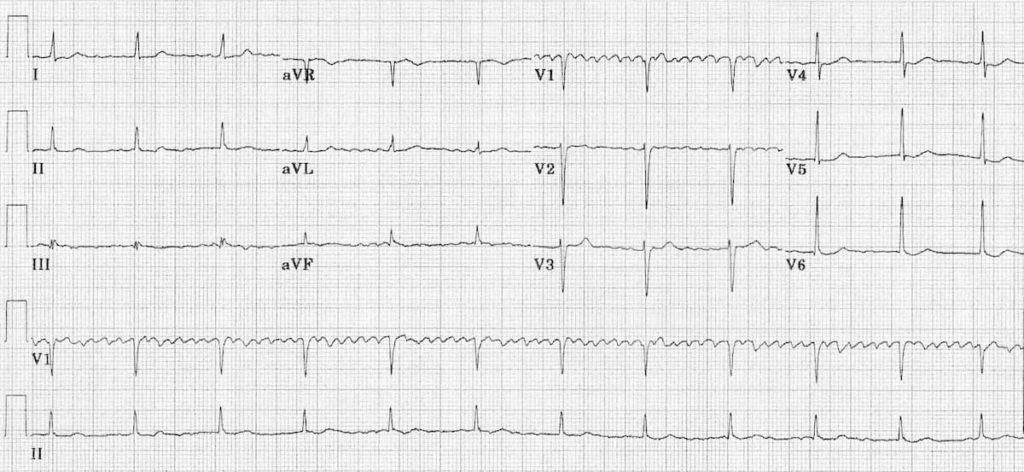 Regularised AF digoxin toxicity