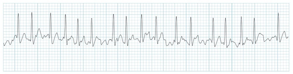 ventricular fibrillation vs atrial fibrillation