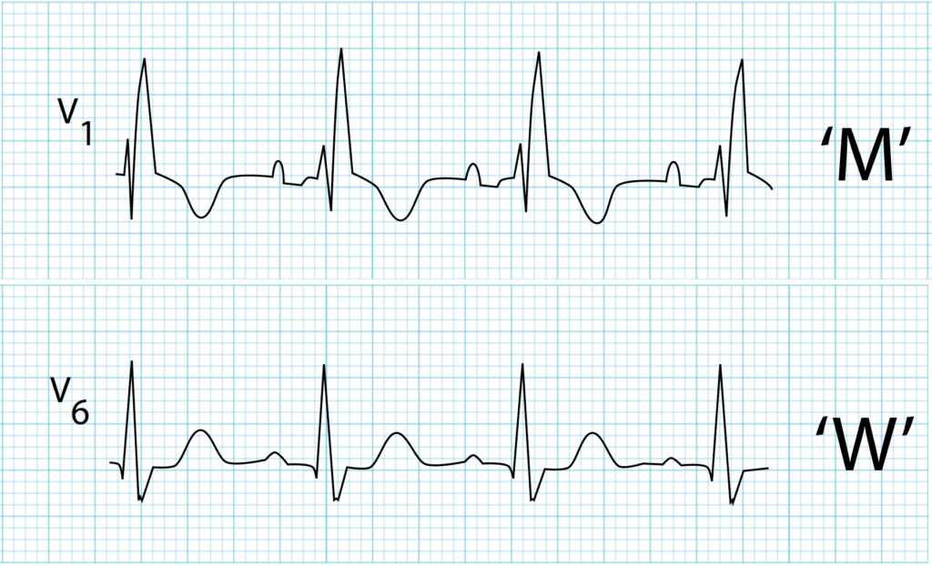 Right-Bundle-Branch-Block-RBBB ECG-Strip LITFL