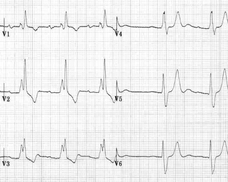 what does a t wave inversion look like