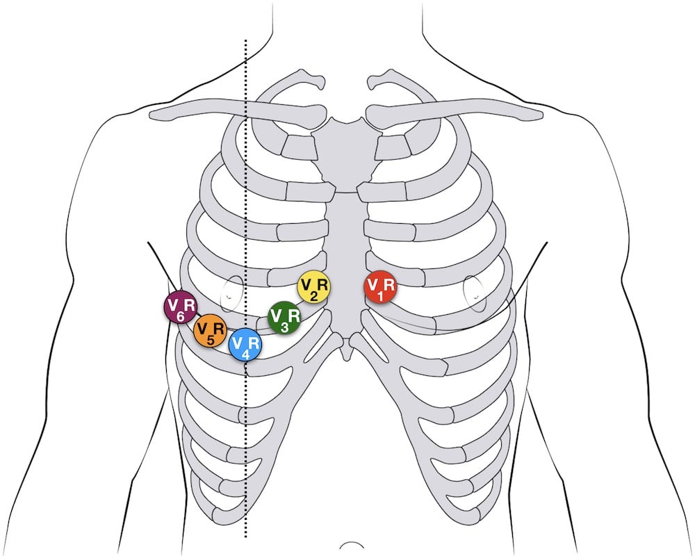 12 Lead Placement Diagram