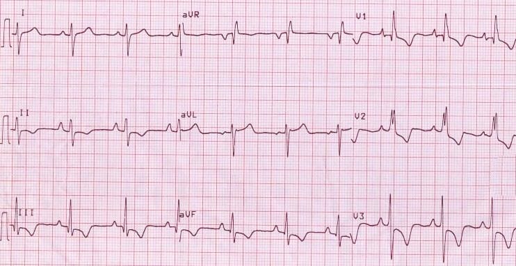 what does a t wave inversion look like