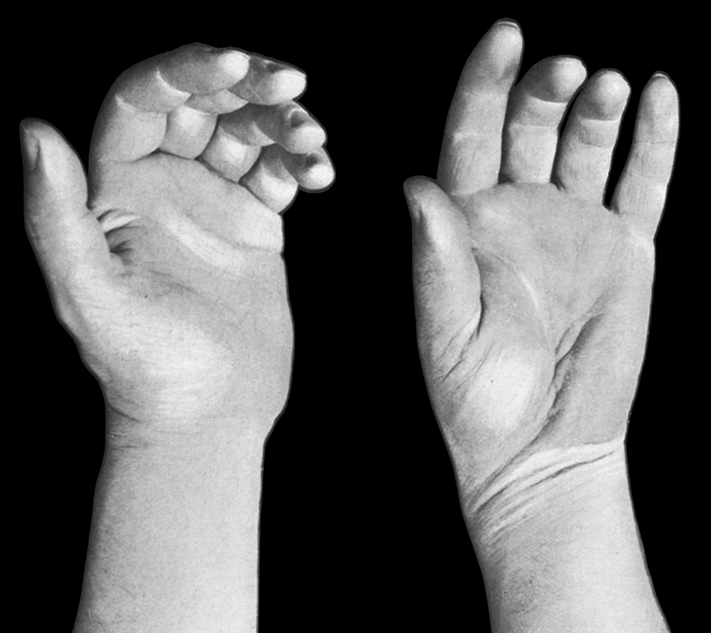 Robert view of the trapeziometacarpal joint 1936