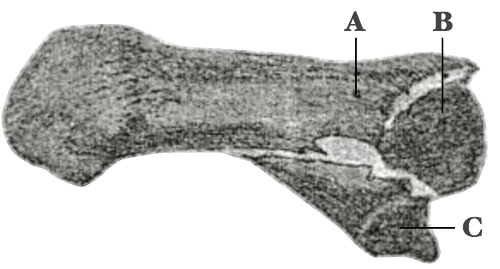 Rolando fracture 1910