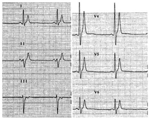 SQTS ECG complex Crotti et al