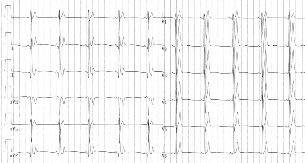 Short QT Syndrome • LITFL • ECG Library Diagnosis