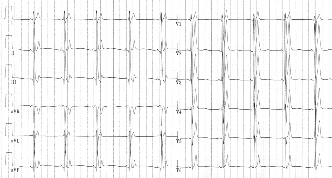 Short QT Syndrome • LITFL • ECG Library Diagnosis