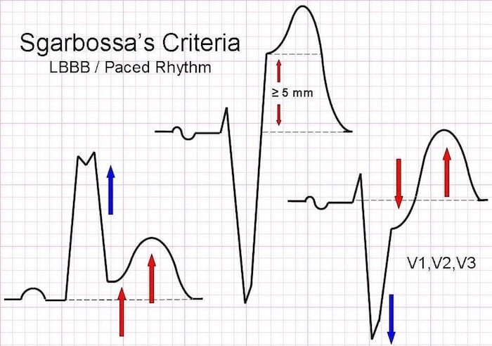 Sgarbossa Criteria LITFL ECG Library Diagnosis