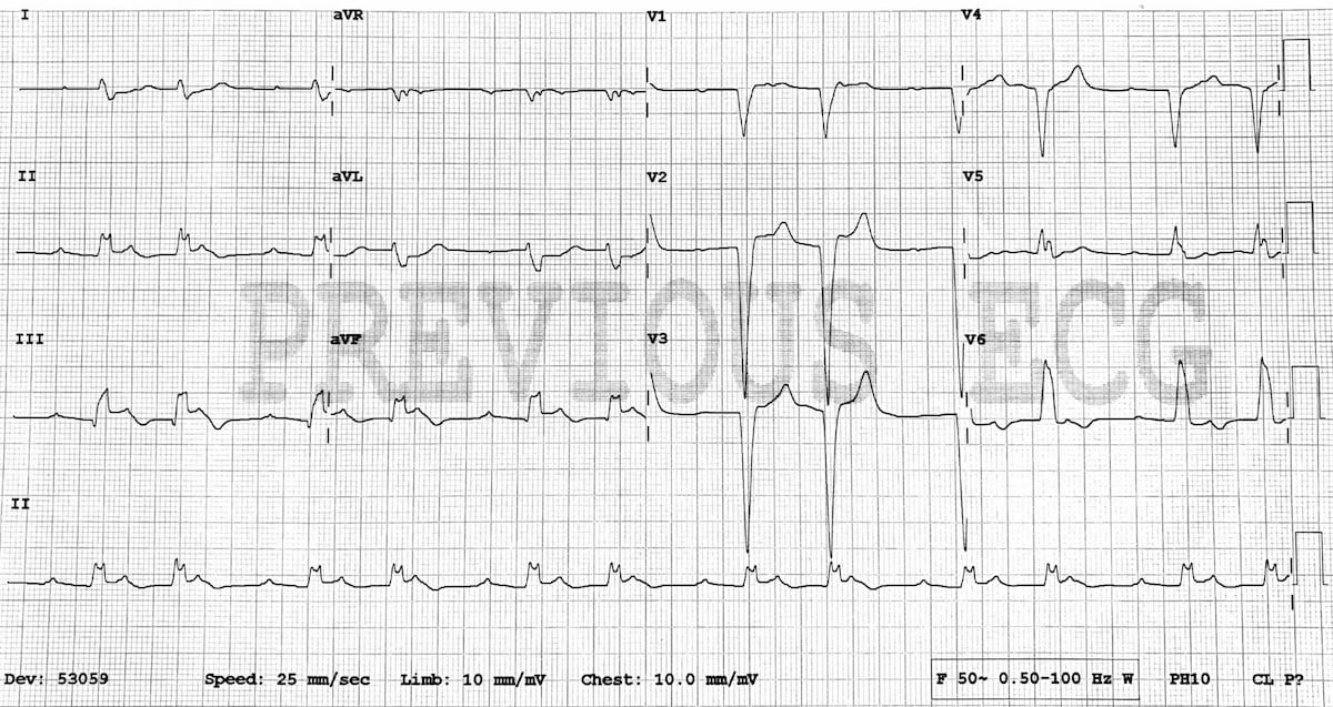 Ecg Litfl Diagnosis Library Block Tachycardia Degree Ventricular Rhythm ...