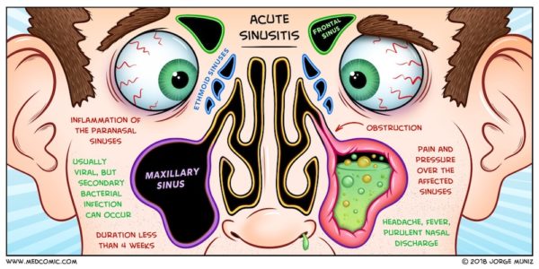 Sinusitis-MEDCOMIC-Jorge-Muniz-