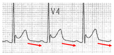 Pericarditis Ecg