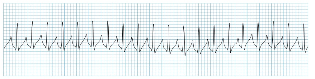 junctional tachycardia vs svt