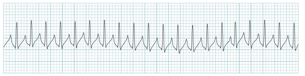 Supraventricular Tachycardia SVT LITFL ECG Library Diagnosis Supraventricular Tachycardia SVT LITFL ECG Library Diagnosis