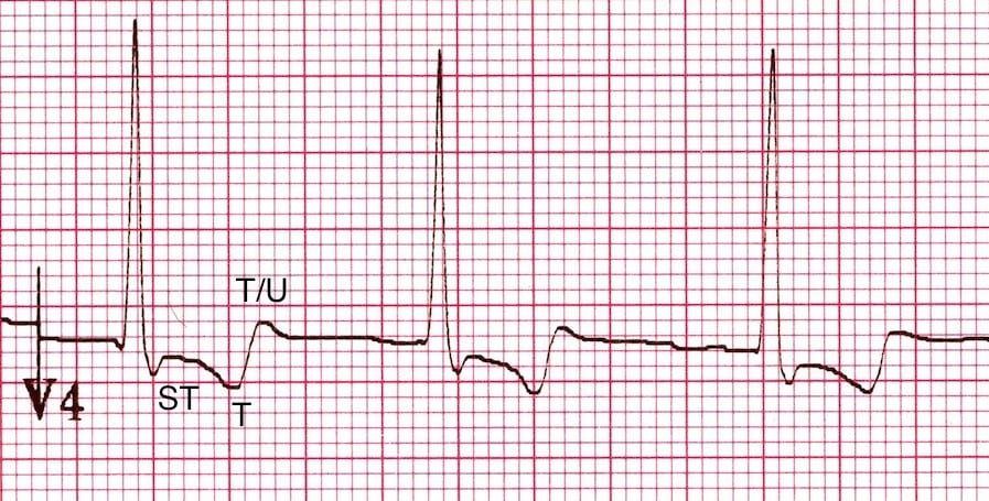 Digoxin Effect • LITFL • ECG Library Toxicology