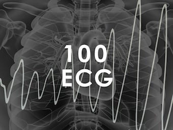 TOP-100-ECG-QUIZ-340