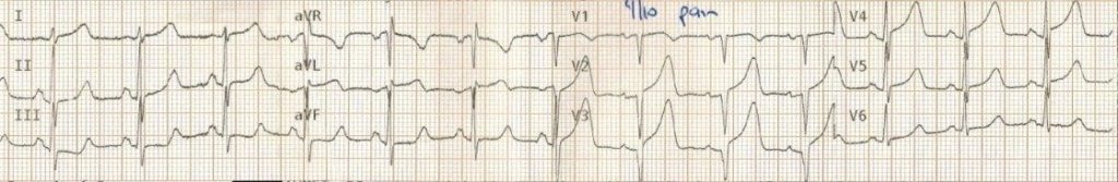 TOP 100 ECG QUIZ LITFL 005 1