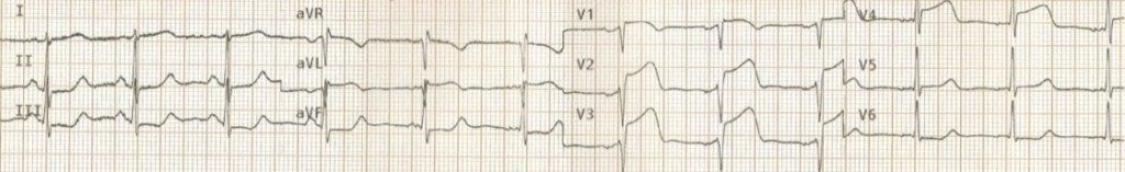 TOP 100 ECG QUIZ LITFL 005 4