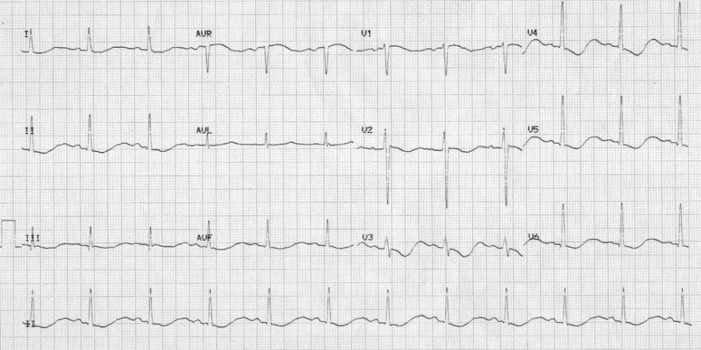 TOP 100 ECG QUIZ LITFL 006 2