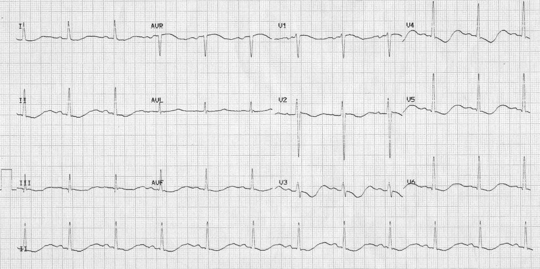 Ecg Case 006 Litfl Ecg Top 100 Self Assessment Quiz