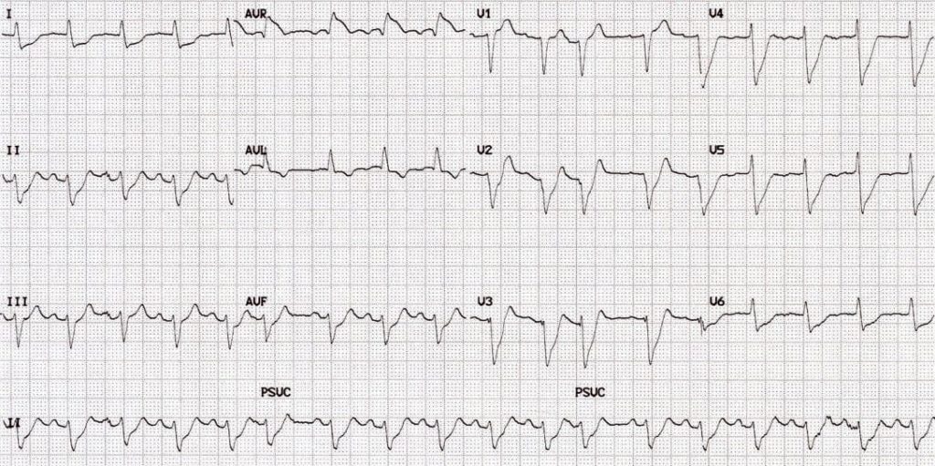 TOP 100 ECG QUIZ LITFL 008 2