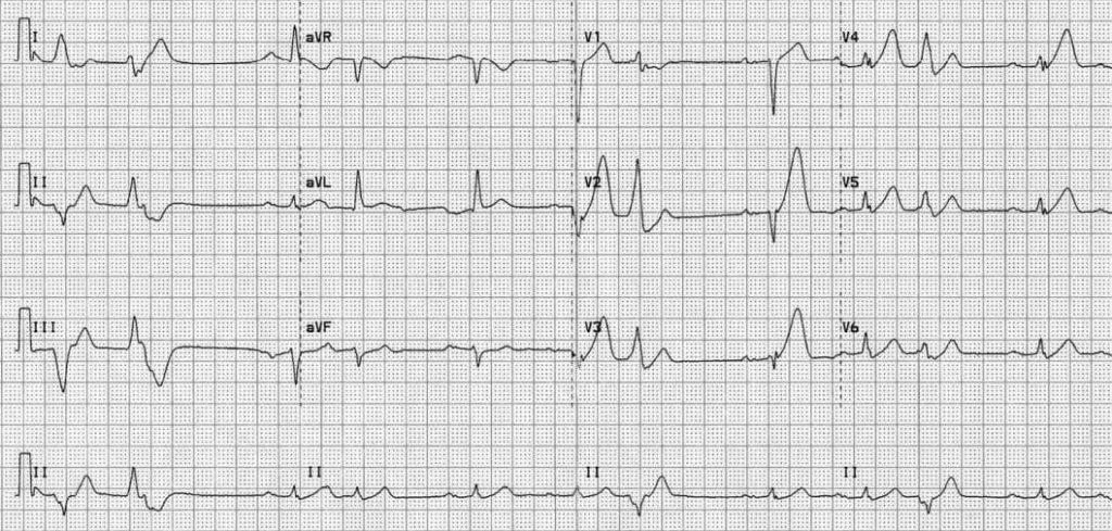 TOP 100 ECG QUIZ LITFL 009 2