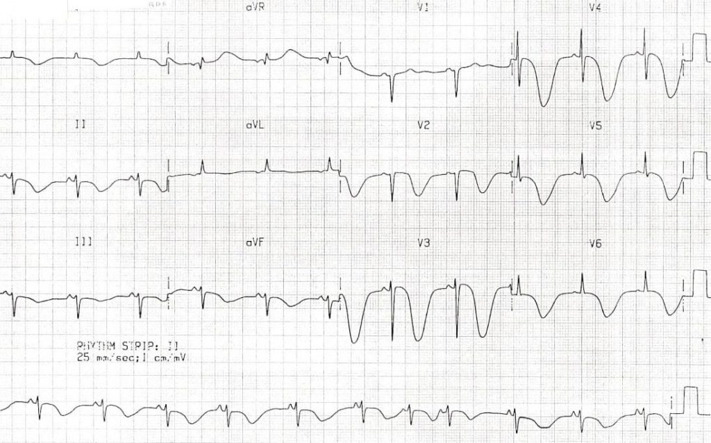 TOP 100 ECG QUIZ LITFL 012 2