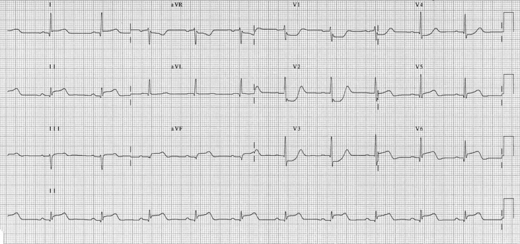 TOP 100 ECG QUIZ LITFL 014