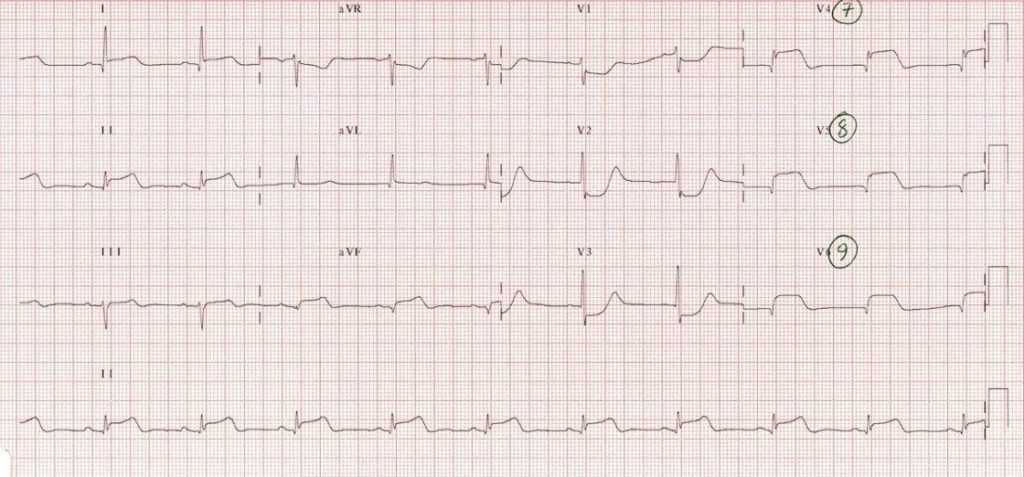 TOP 100 ECG QUIZ LITFL 015