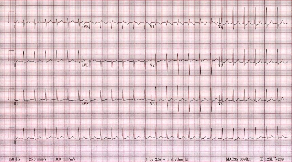 TOP 100 ECG QUIZ LITFL 016