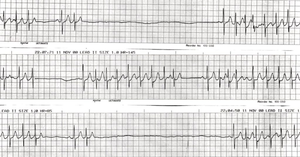 TOP 100 ECG QUIZ LITFL 020