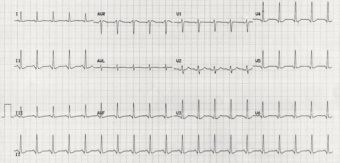 ECG Case 022 • LITFL • ECG Top 100 Self-Assessment Quiz