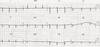 ECG Case 024 • LITFL • ECG Top 100 Self-Assessment Quiz