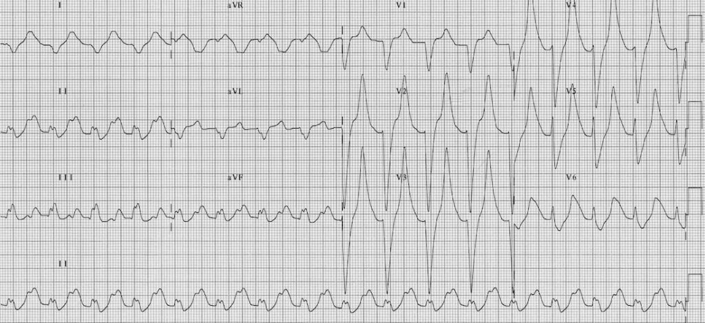 TOP 100 ECG QUIZ LITFL 027 2