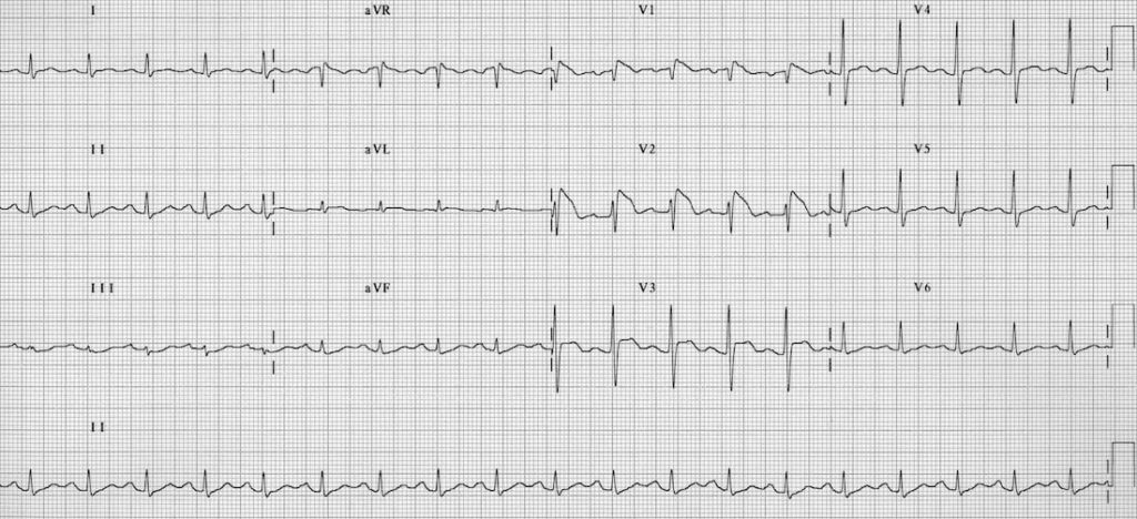 TOP 100 ECG QUIZ LITFL 028 2