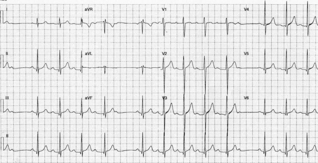 TOP 100 ECG QUIZ LITFL 029 2