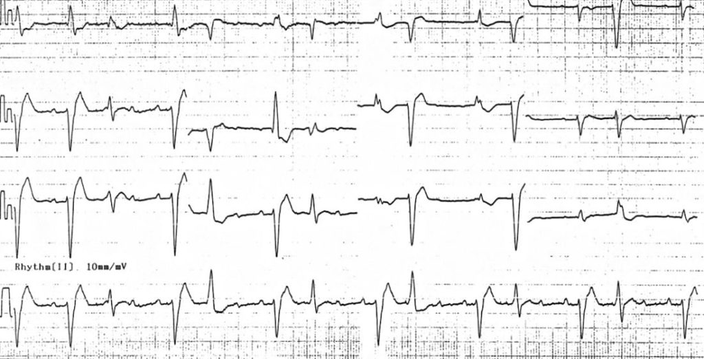 ECG Case 030 • LITFL • ECG Top 100 Self-Assessment Quiz