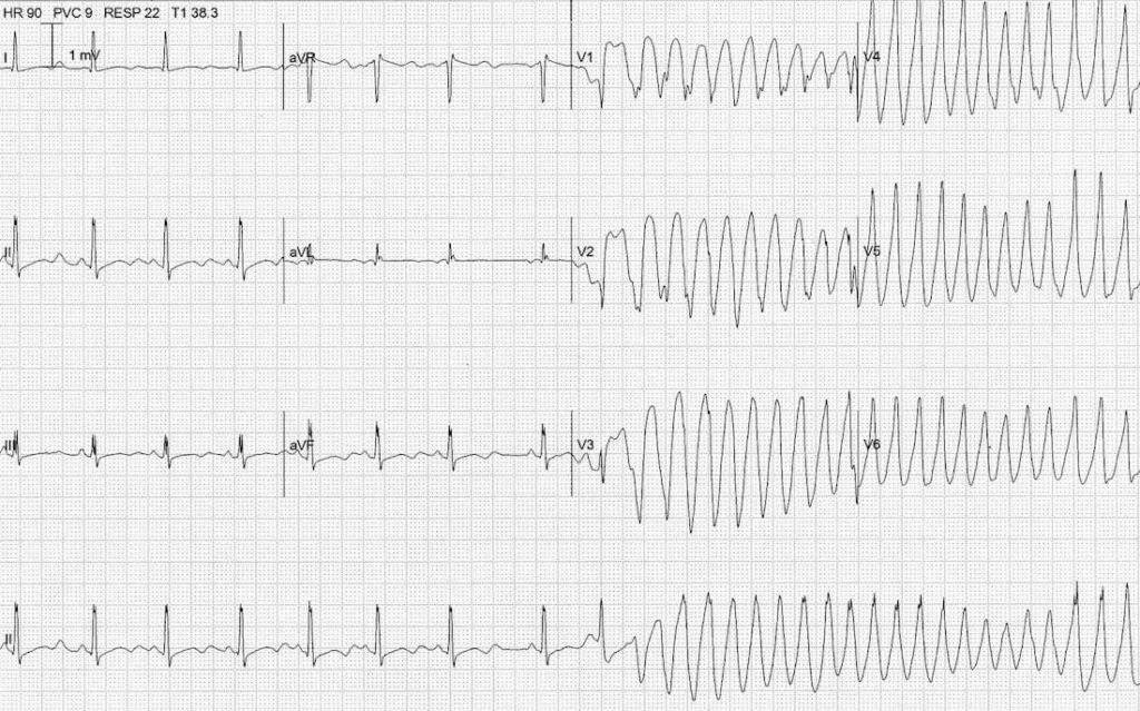 TOP 100 ECG QUIZ LITFL 031 3