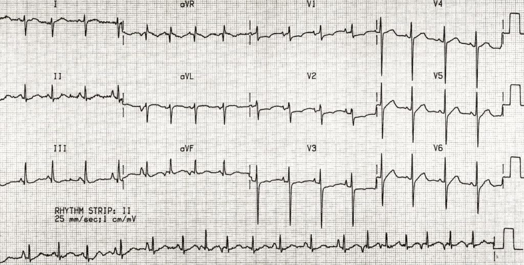 TOP 100 ECG QUIZ LITFL 033