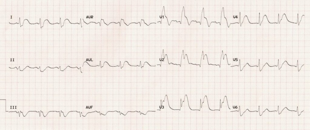 TOP 100 ECG QUIZ LITFL 034