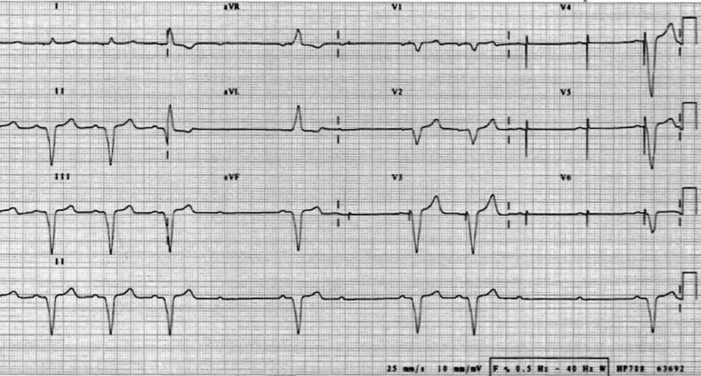 TOP 100 ECG QUIZ LITFL 035 2