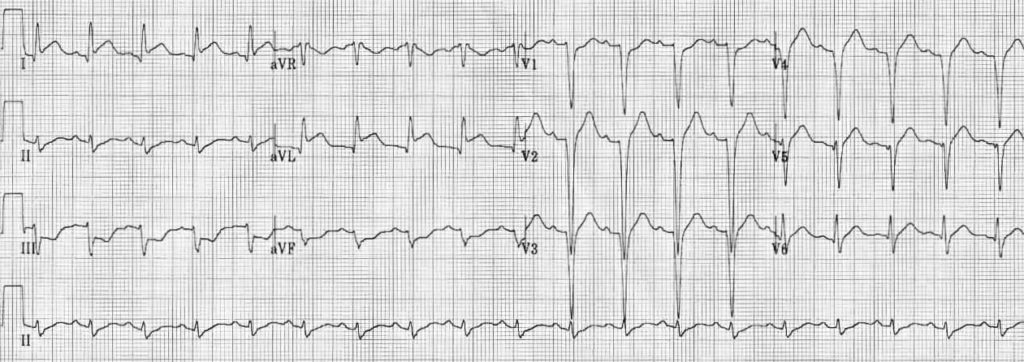 TOP 100 ECG QUIZ LITFL 036 2