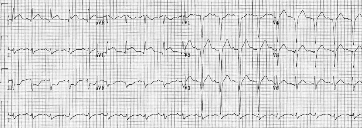 ECG Rate Interpretation • LITFL Medical Blog • ECG Library Basics