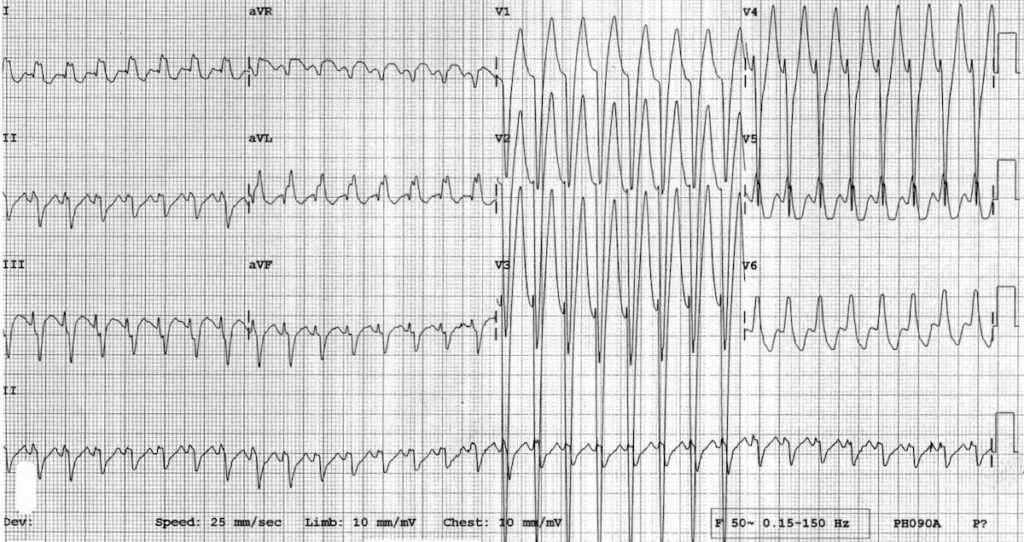 TOP 100 ECG QUIZ LITFL 038 2