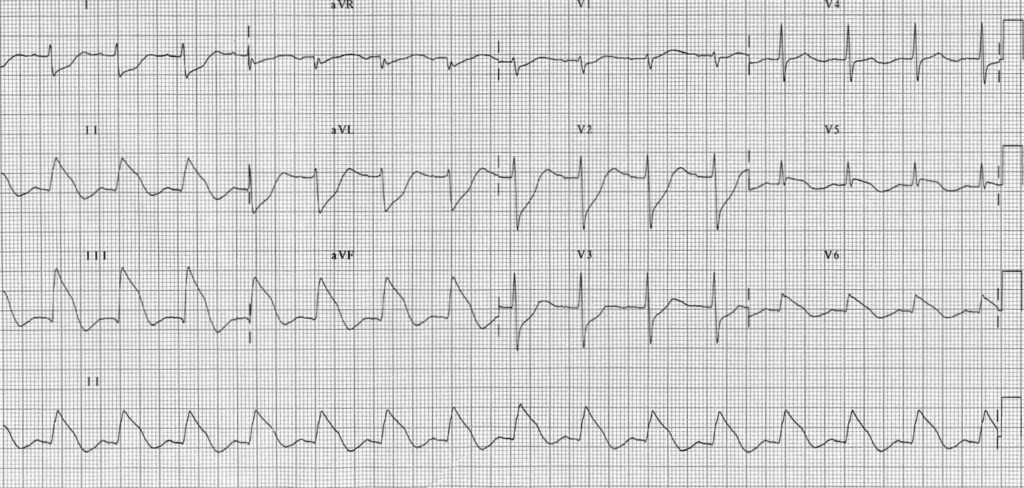 TOP 100 ECG QUIZ LITFL 039 2