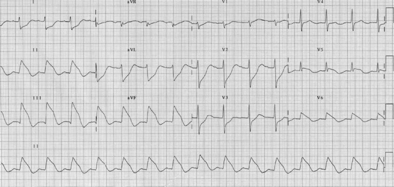 ECG Case 039 • LITFL • ECG Top 100 Self-Assessment Quiz