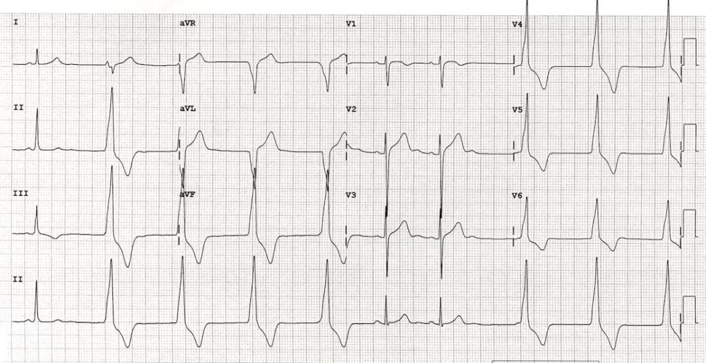 TOP 100 ECG QUIZ LITFL 040