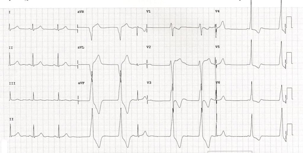 TOP 100 ECG QUIZ LITFL 040b