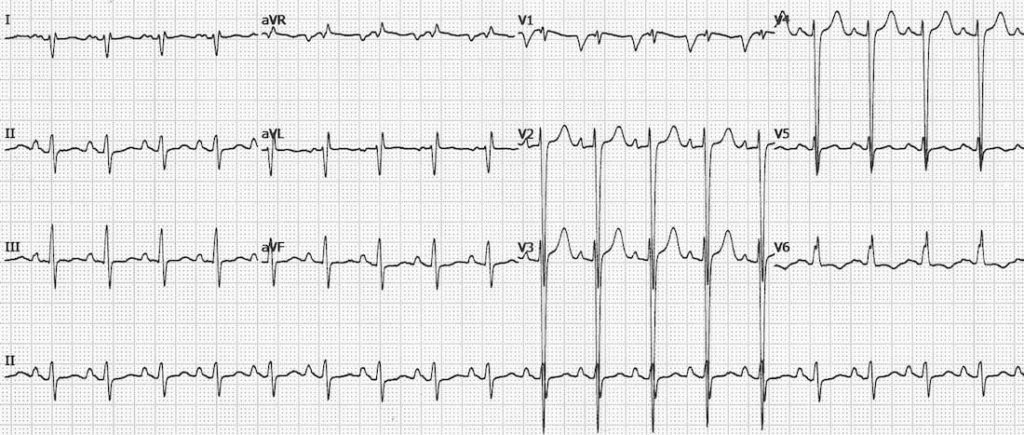 TOP 100 ECG QUIZ LITFL 041