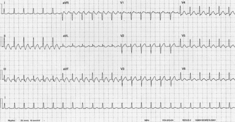 ECG Case 042 • LITFL • ECG Top 100 Self-Assessment Quiz