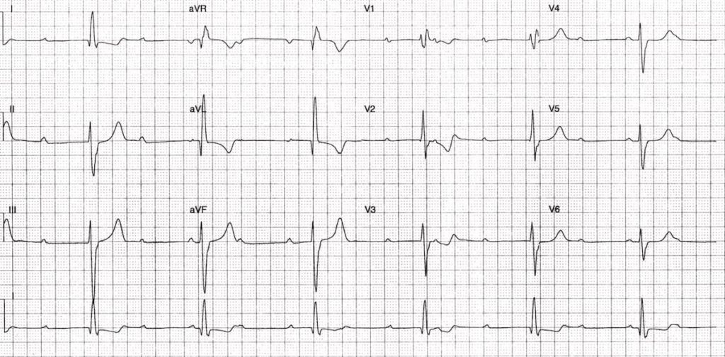 TOP 100 ECG QUIZ LITFL 044